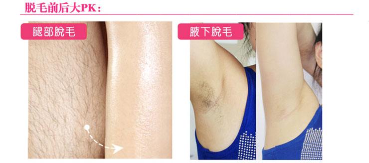 激光脫毛、