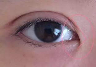 開(kāi)眼角上的傷口大概多久能才愈合