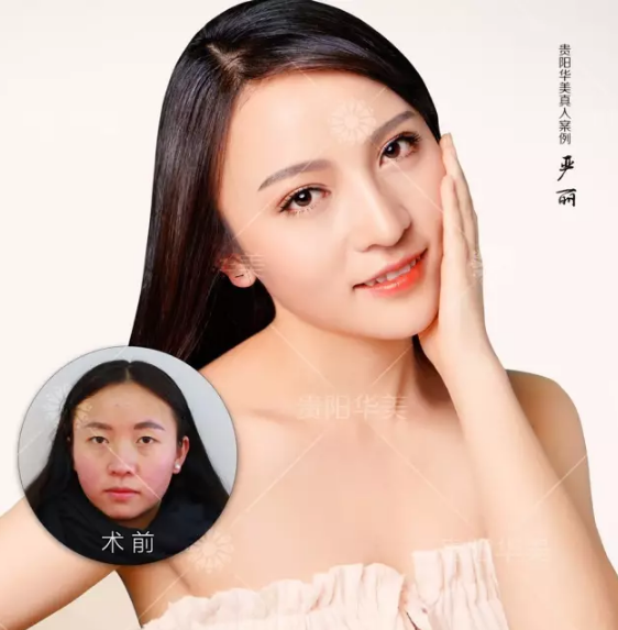 貴陽(yáng)激光美白美容手術(shù)費(fèi)用要多少錢呢