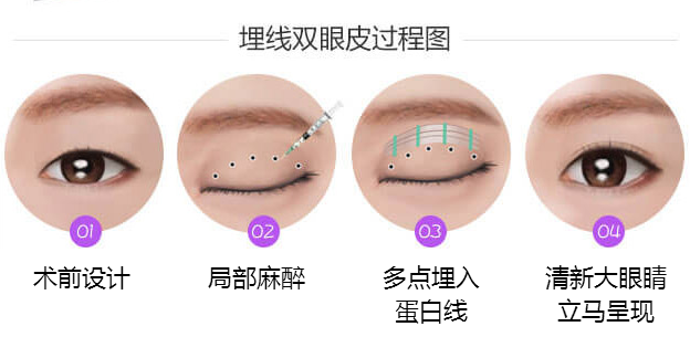 埋線(xiàn)雙眼皮術(shù)后多長(zhǎng)時(shí)間恢復(fù)正常