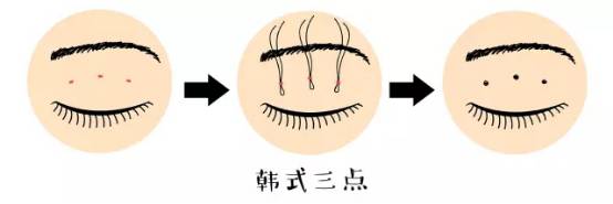 雙眼皮