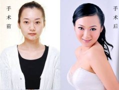 豐胸手術(shù)需要多少錢 會有風(fēng)險(xiǎn)嗎?