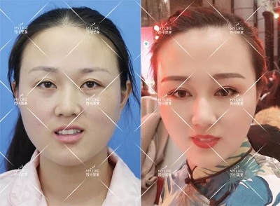 有些眼睛雙眼皮拯救不了，就來<a href='/suz/' target='_blank'><u>蘇州美萊</u></a>做眼綜合手術！
