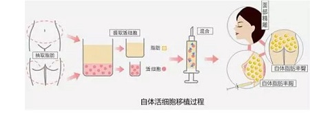 吸脂豐胸多少錢(qián)