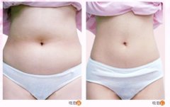 武漢適合做吸脂減肥手術(shù)的年齡段是多少？