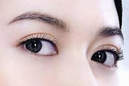 埋線(xiàn)雙眼皮