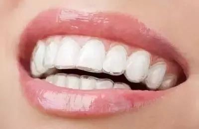 鑲牙多少錢(qián)？