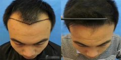 頭發(fā)種植后怎么護(hù)理？