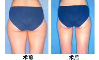 南京臀部吸脂減肥價格要多少錢？