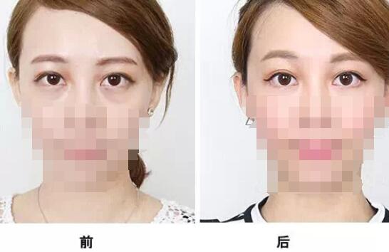 深圳眼袋整形術(shù)需要多少錢？