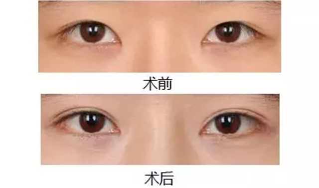 南京做韓式三點(diǎn)雙眼皮價(jià)錢(qián)是多少？