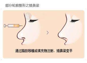 武漢注射玻尿酸隆鼻多少錢？