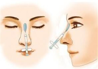 重慶注射玻尿酸隆鼻價(jià)格？
