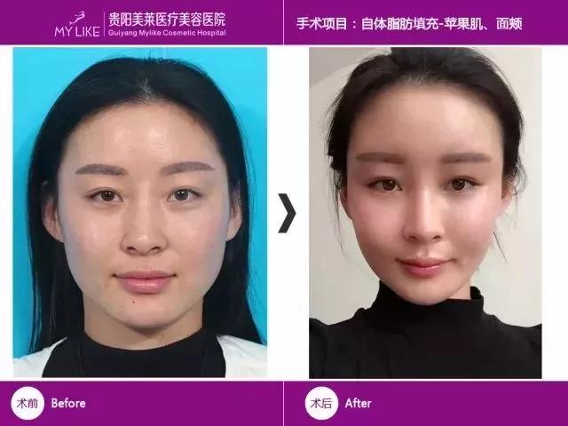 自體脂肪填充