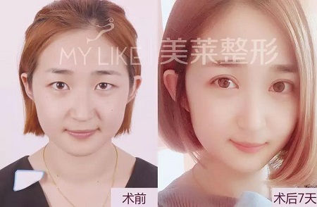 美萊眼部整形醫(yī)師—畢小麗主任，3月23日親診石家莊美萊。