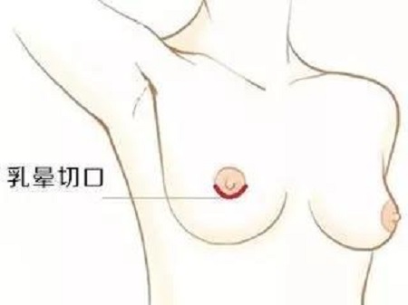 隆胸