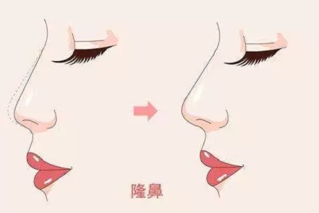 聽說(shuō)，這兩種鼻子一看就知道是整的？