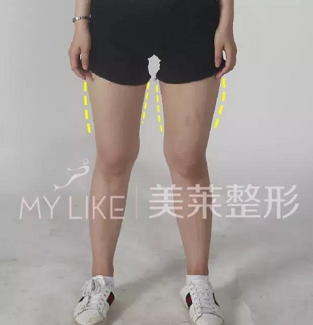 減肥