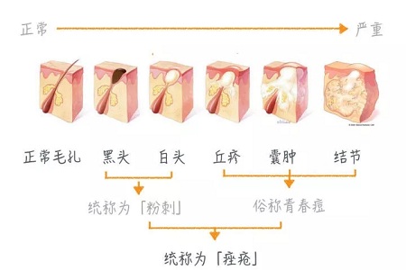 擠痘竟然被送進ICU！你的痘痘還好嗎？