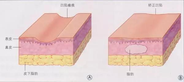 自體脂肪填充為什么需要二次補打？