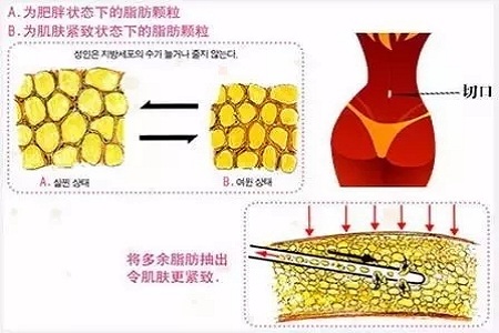 吸脂，怎樣做才算是剛剛好？