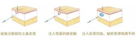 法令紋、川字紋