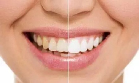牙齒發(fā)黃怎么辦？還有救嗎？