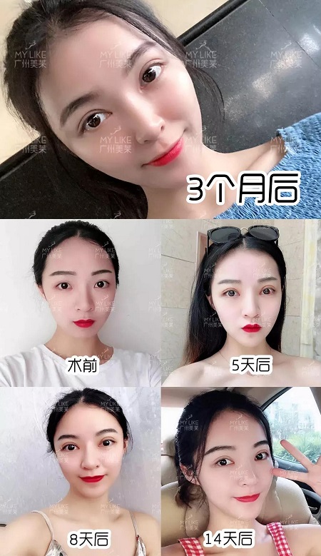 雙眼皮