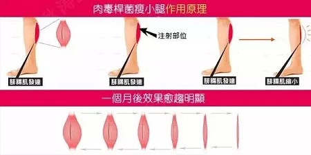 這有一個快速又持久瘦小腿的方法！請注意查收！