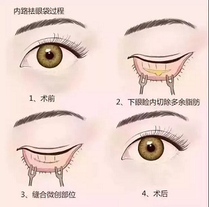 美萊實(shí)驗(yàn)室：分型祛除眼袋，拒絕+10歲