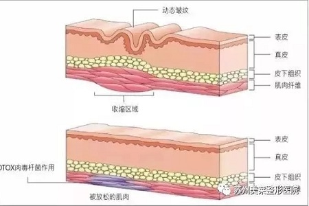 你無(wú)法用玻尿酸除掉所有皺紋！