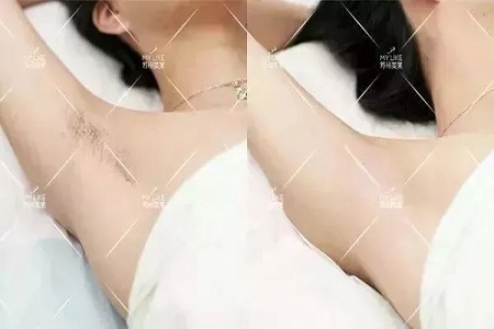 這是夏天變美較簡單的方法！-脫毛