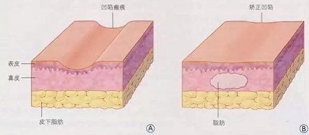 明星的臉和你的臉差的只是這一步！--面部脂肪填充