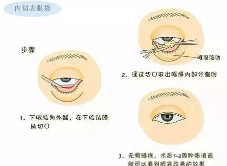 還把眼袋當臥蠶？那就別怪小弟弟喊你阿姨了