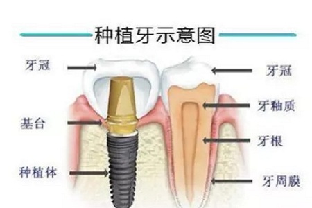 揭秘牙齒矯正的全過程?。?！