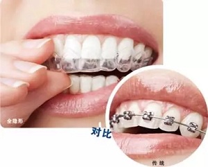 告別鋼牙妹——隱形矯正新時代，拯救尷尬的微笑！