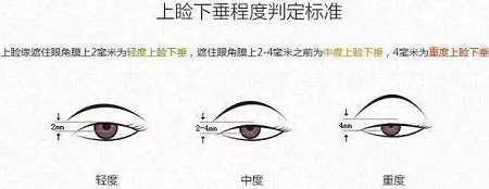 據(jù)說80%的亞洲女性都有這一眼部通病，上瞼下垂你了解過嗎？