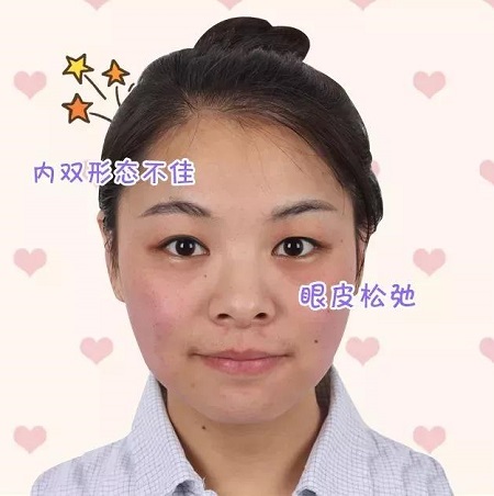 割雙眼皮