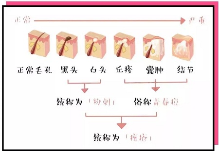 痤瘡的分類(lèi)