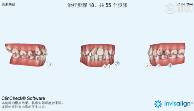 南京美萊口腔全景側(cè)位片，拍照取模，動畫方案設計