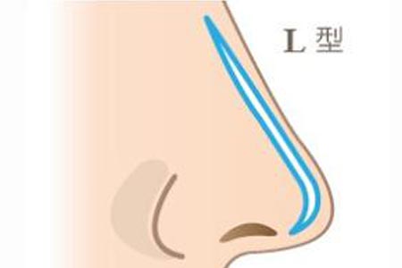 假體隆鼻失敗修復(fù)需要花費多少錢