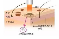 西安整形醫(yī)院做點陣激光多少錢，一次有效果嗎