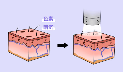 想要嫩膚，應(yīng)該選擇做光電還是水光